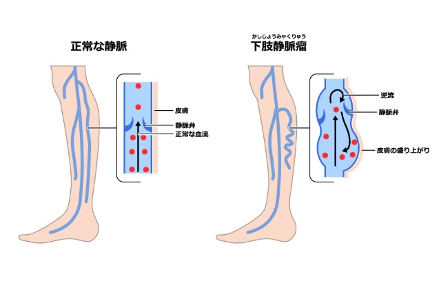 下肢静脈瘤イラスト